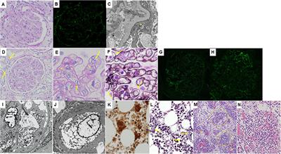 TAFRO Syndrome in a Kidney Transplant Recipient That Was Diagnosed on Autopsy: A Case Report